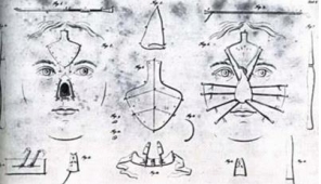 고대 인도의 코 성형수술 기록